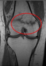 MRI