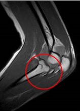 MRI