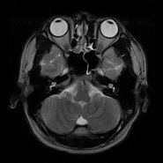 MRI