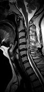 MRI