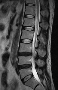 MRI