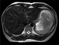 MRI